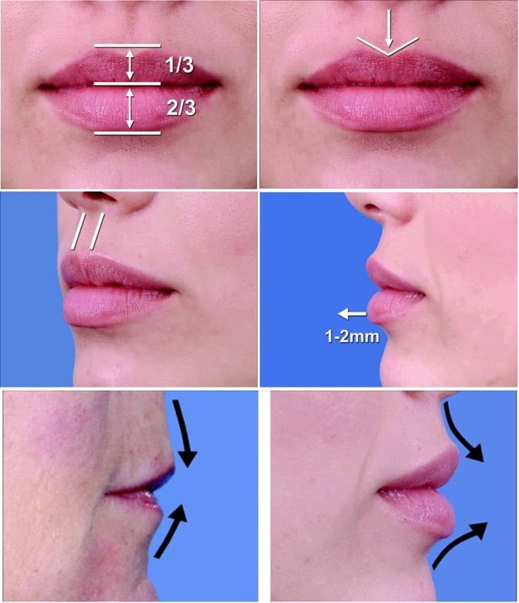 Aumento de labios con ácido hialurónico, corrección de asimetrías, revitalización labial.