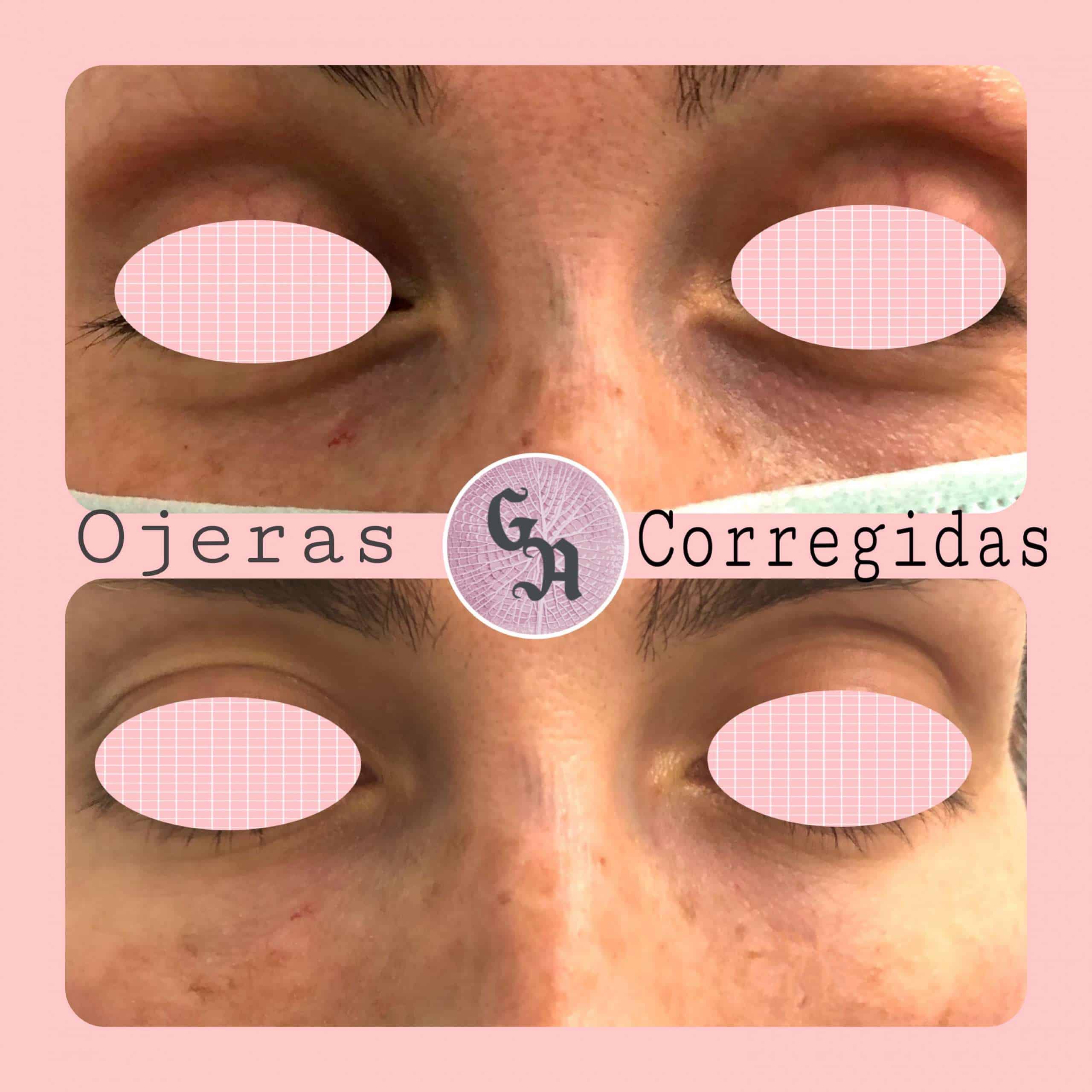 tratamiento ojeras zaragoza resultados