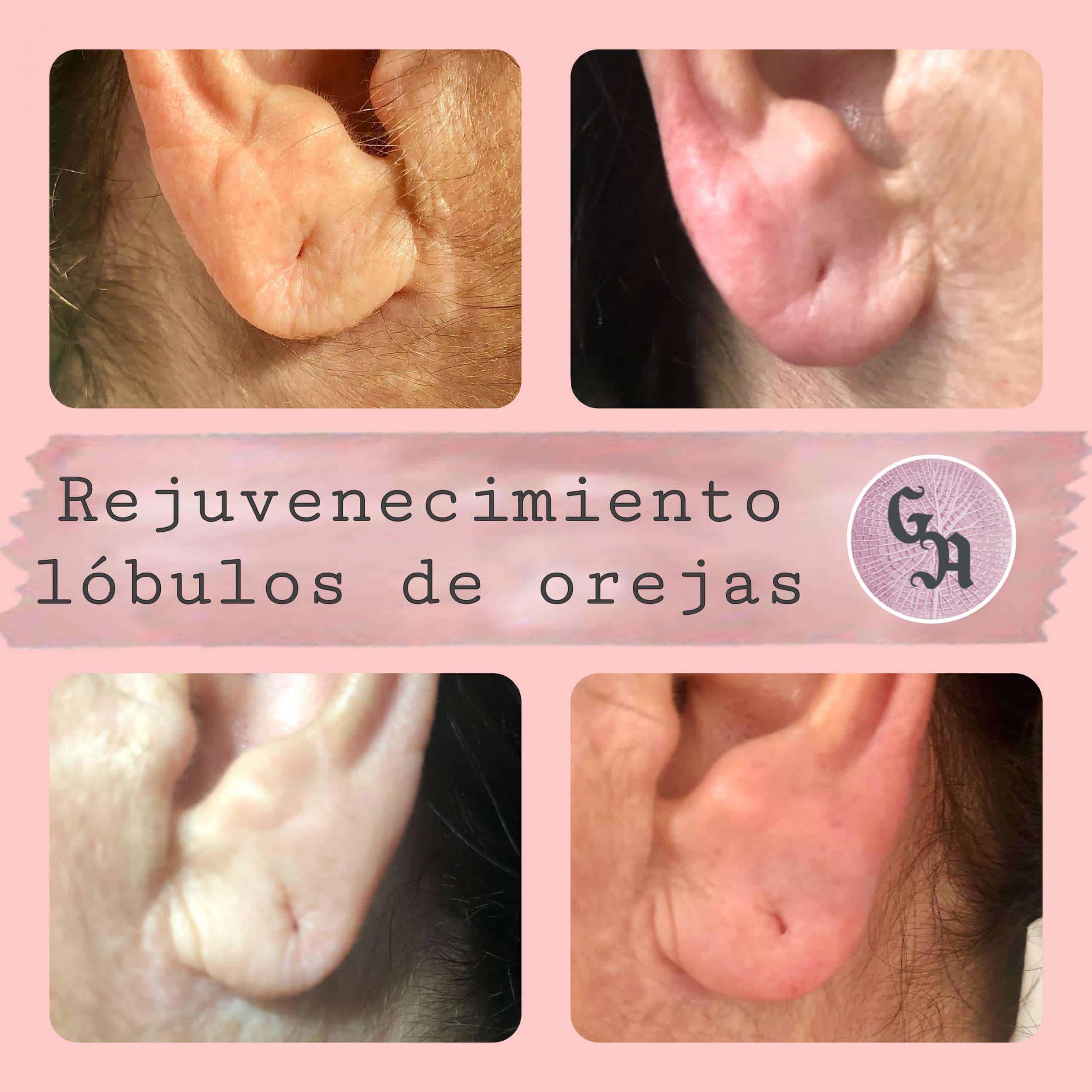 resultados lobulo oreja con hialuronico