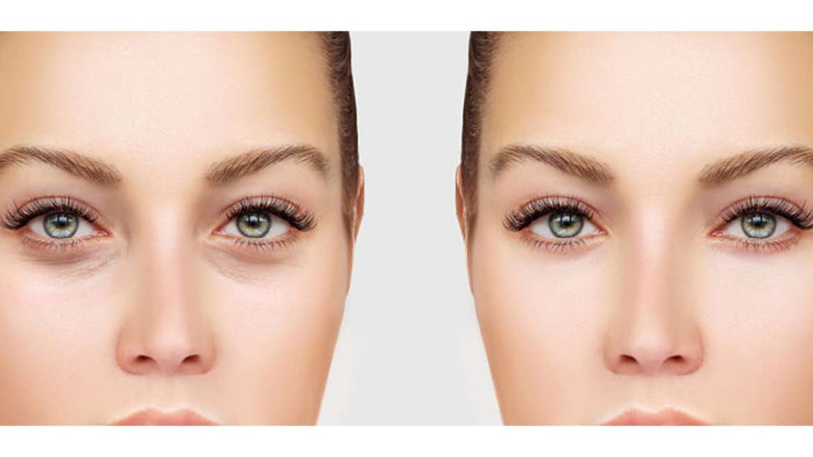 Tratamiento Ojeras y Caída de Cejas