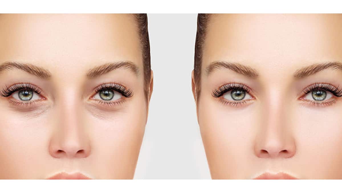 Tratamiento Ojeras y Caída de Cejas