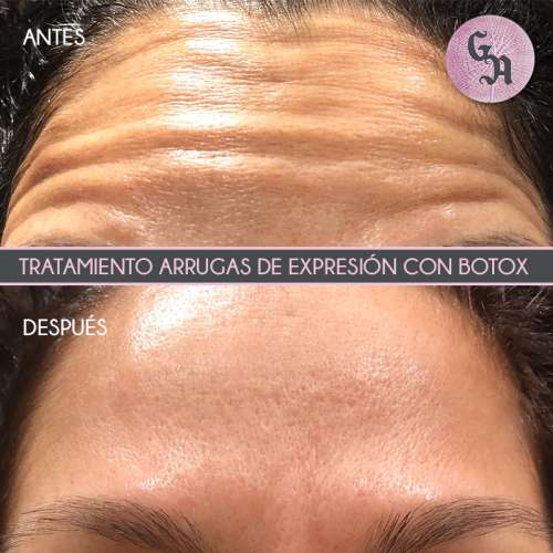 resultados arrugas con botox