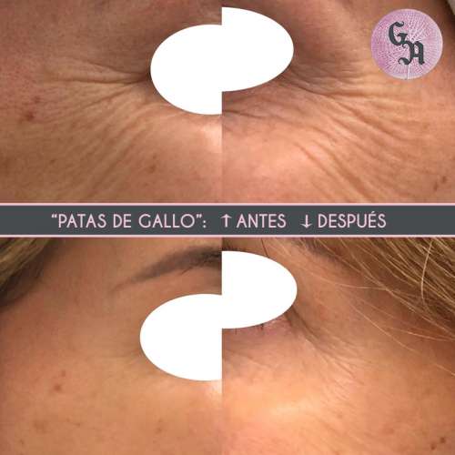 patas de gallo antes y despues botox