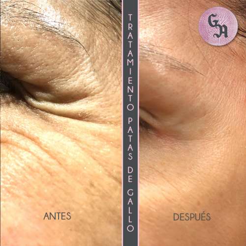 resultados arrugas en ojos: patas de gallo