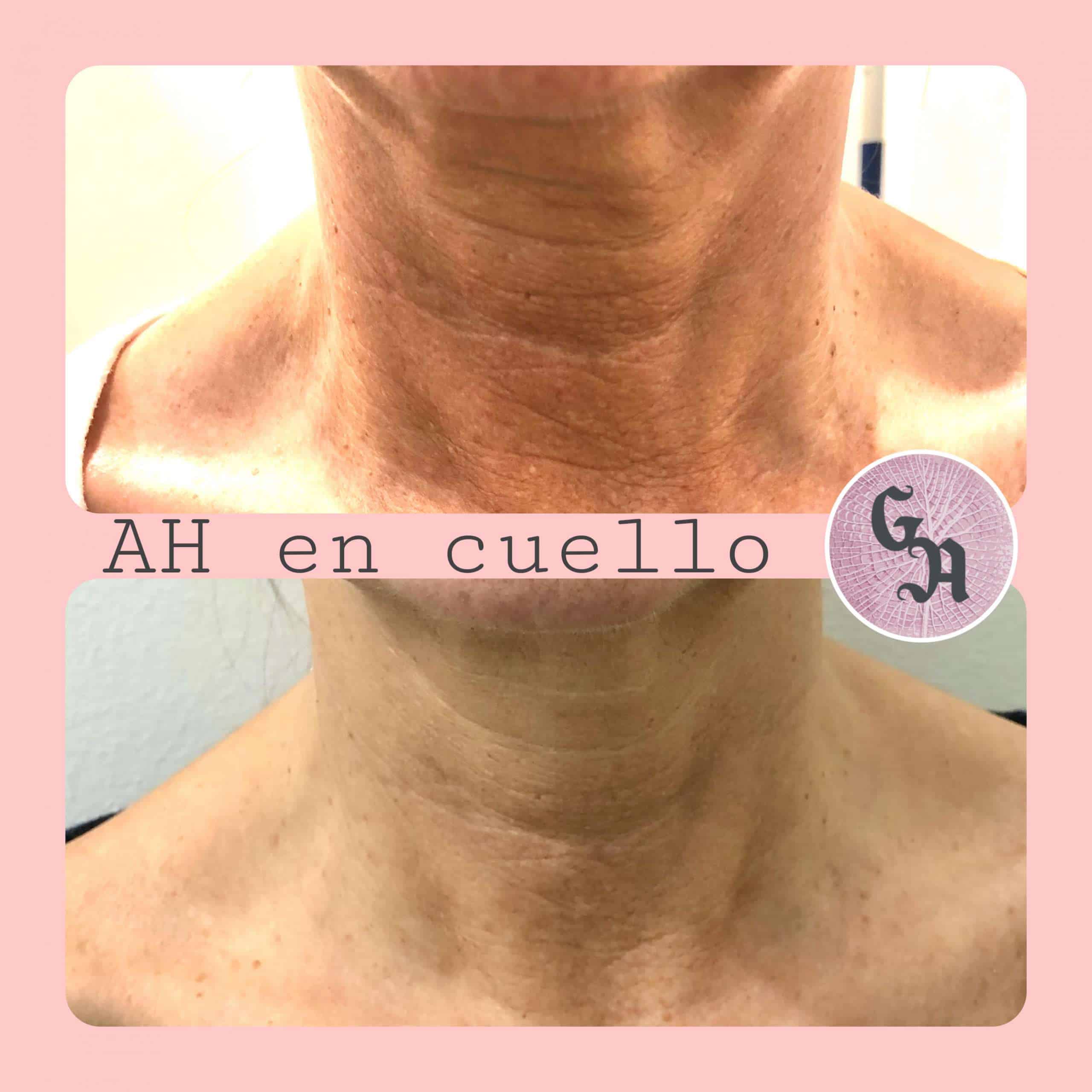 tratamiento cuello zaragoza