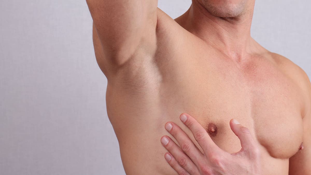 Sudor Excesivo en Hombres