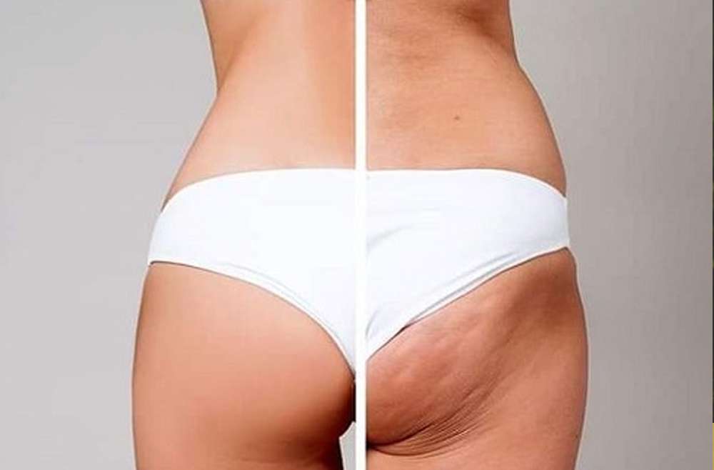 ¿CÓMO SE ELIMINA LA CELULITIS?
