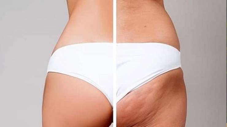¿CÓMO SE ELIMINA LA CELULITIS?