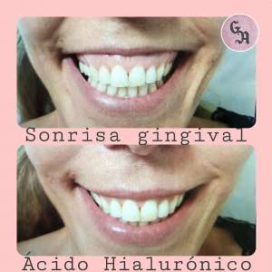 resultados sonrisa gingival, antes y despues, medicina estetica zaragoza, casos reales, exceso encia al sonreir