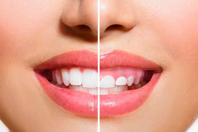 SONRISA GINGIVAL en Zaragoza