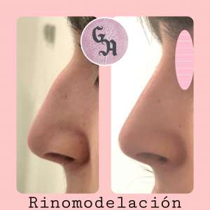 Rinomodelación en Zaragoza