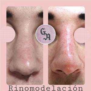 antes y despues, resultados reales, rinomodelación, remodelacion nariz, hialuronico, medidina estetica zaragoza